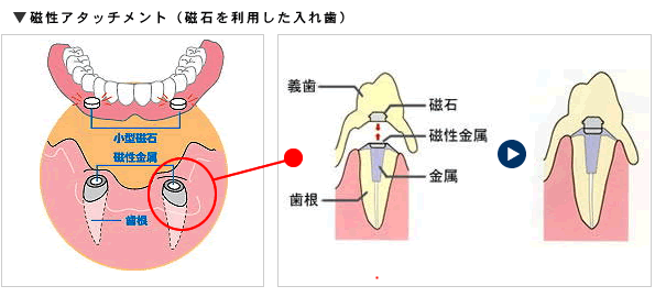 入れ歯の仮画像2