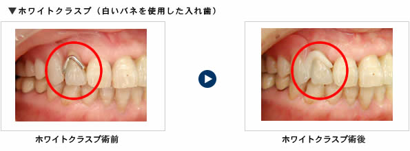 入れ歯の仮画像3